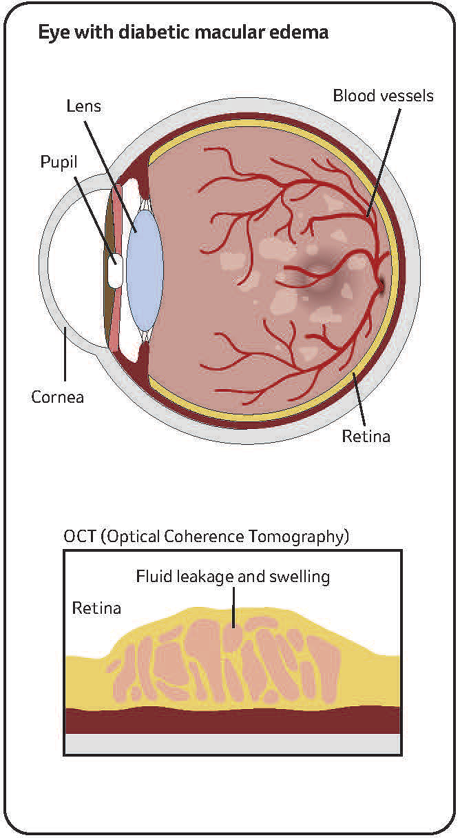 illustration of an eye with DME