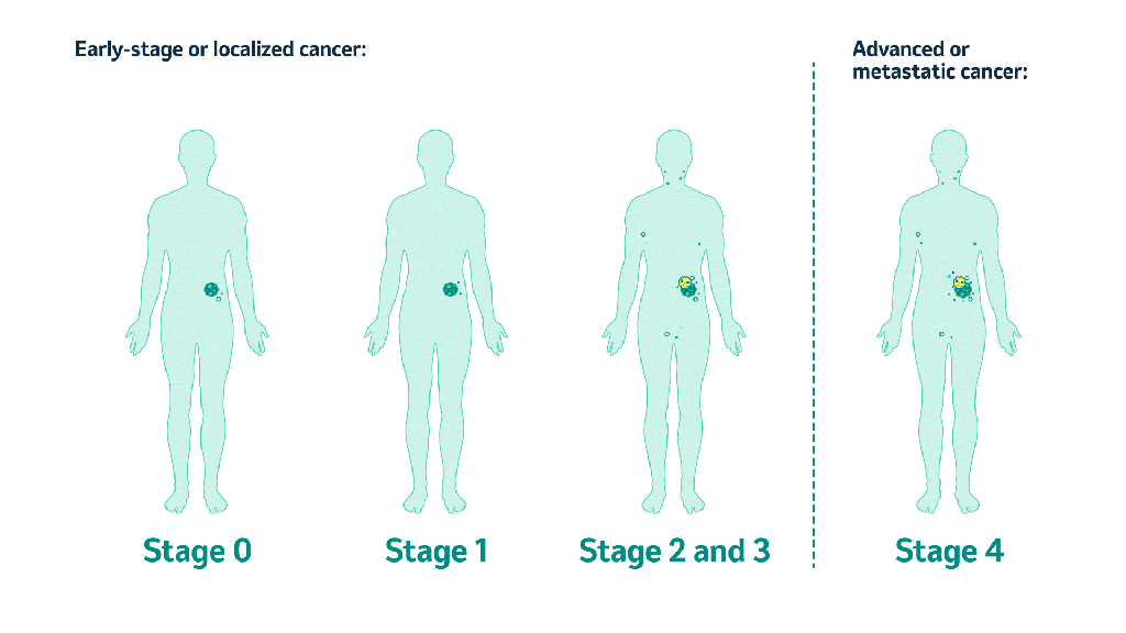 animated GIF of the four stages of cancer